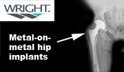Georgia Wright Conserve Hip Replacement Recall Lawyer