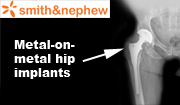 Georgia Smith and Nephew Hip Replacement Recall Lawyer